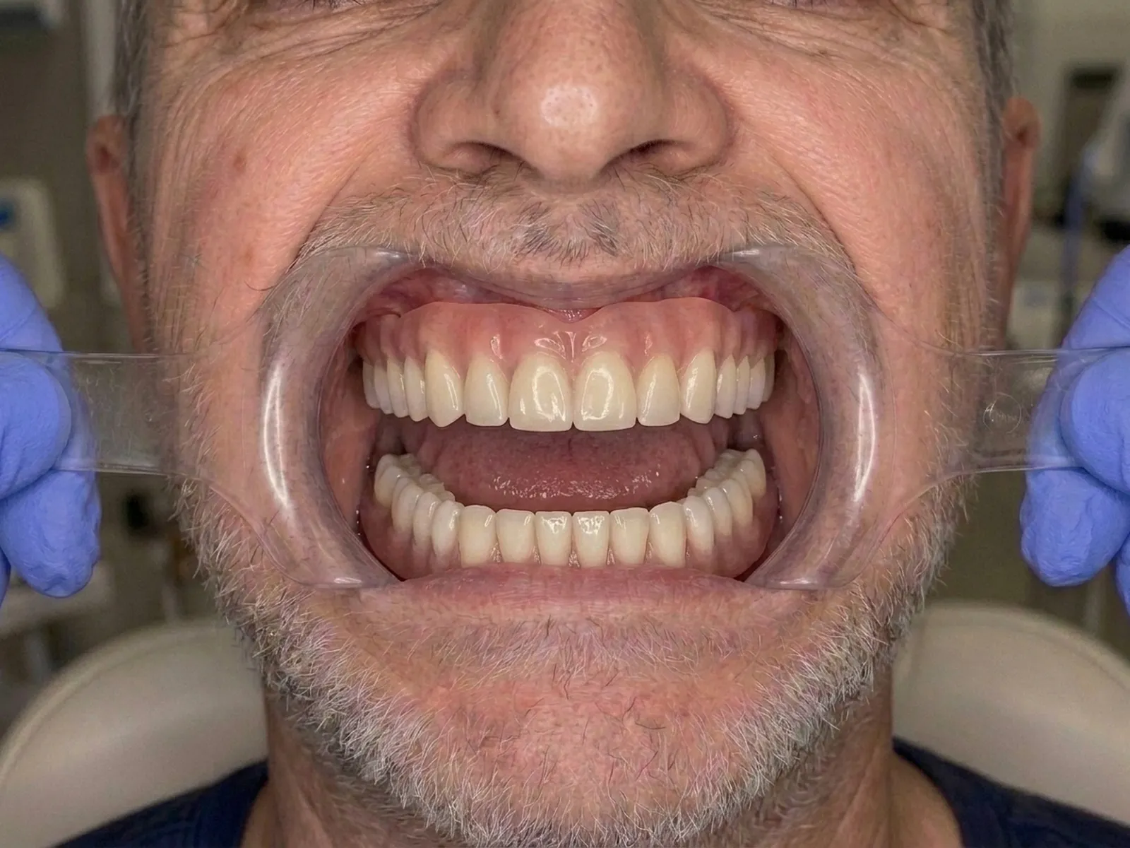 After full-arch implant restoration