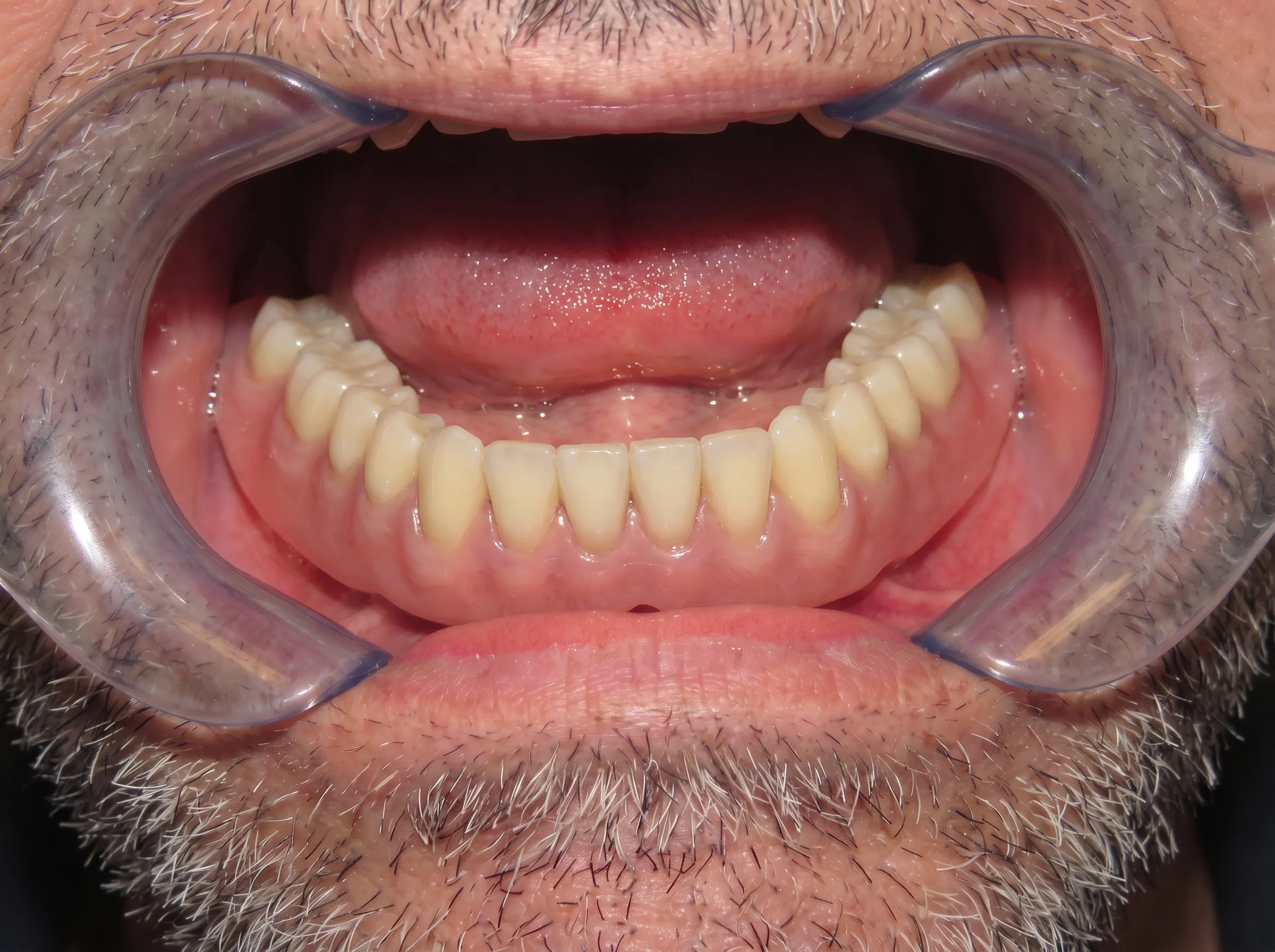 After implant-supported denture