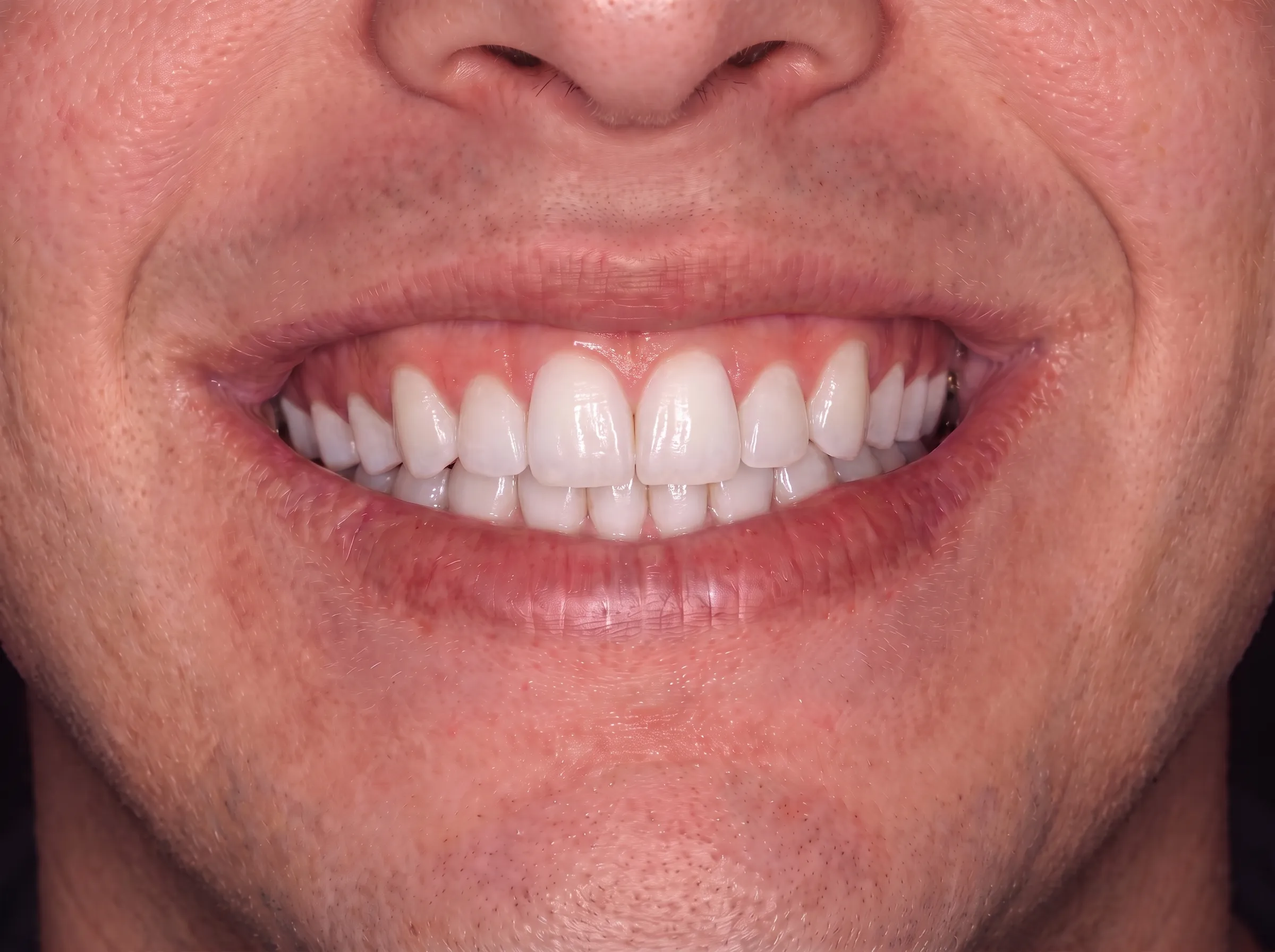 After professional teeth whitening