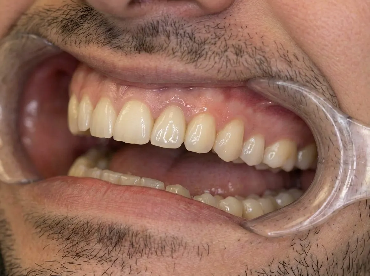 After single implant with custom crown