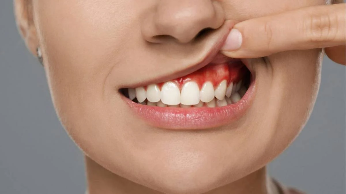 Dental Abscess