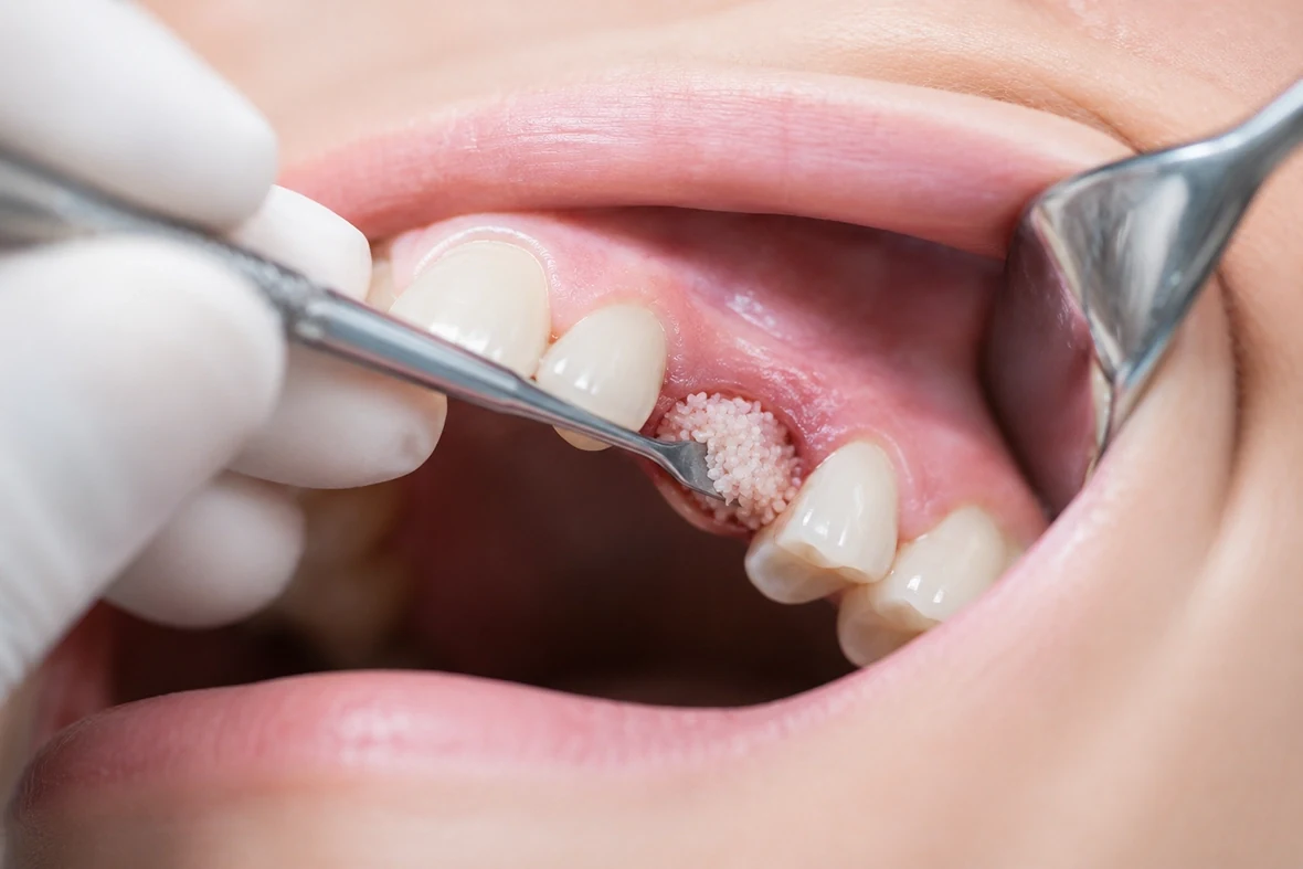 Bone Grafting