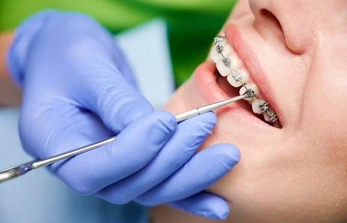 Braces