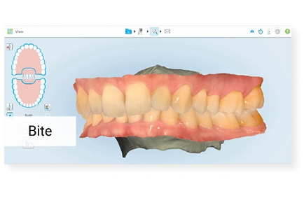 A 3D digital scan of a patient's teeth and bite