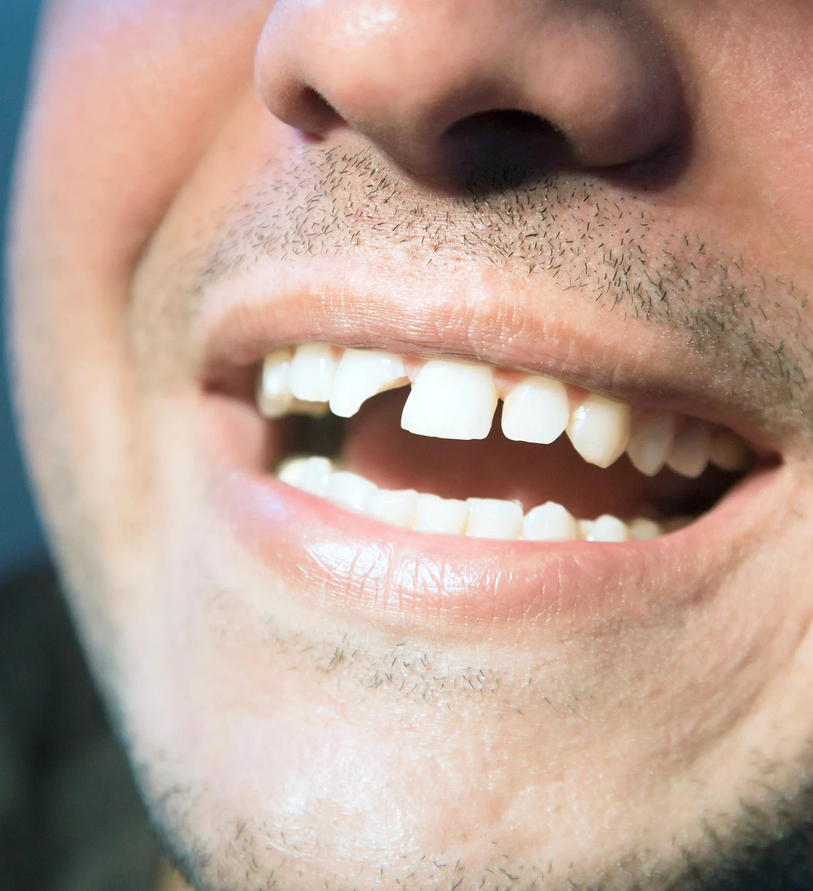 Dentist examining a tooth that may need a crown