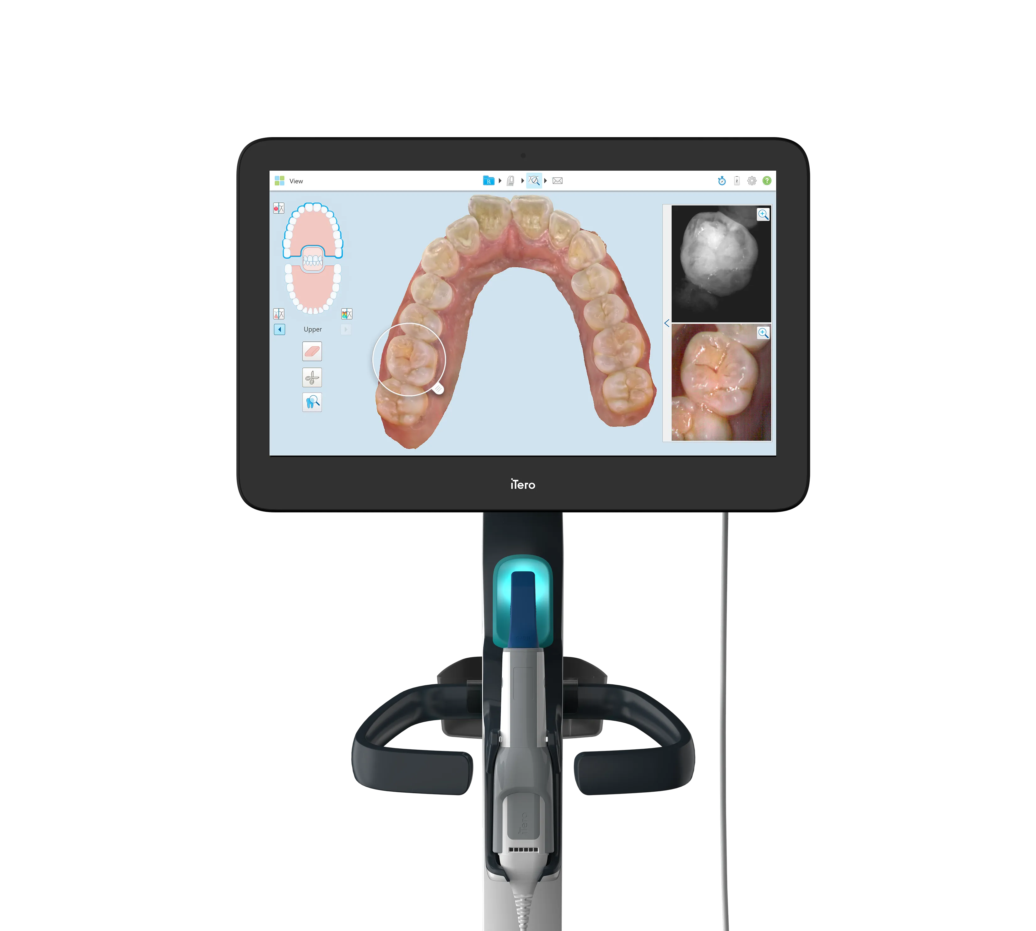 The iTero scanner in our office, showing a 3D scan of a patient's upper arch on screen